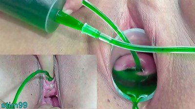 Cervix and urinate fuckhole Inflation with insertions for asian lesbians